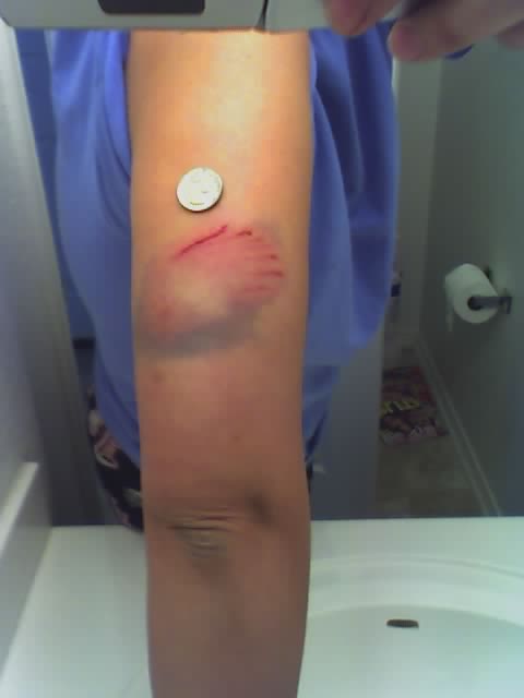 graphic image of dog bite