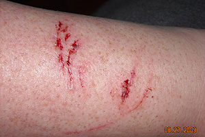 graphic image of dog bite