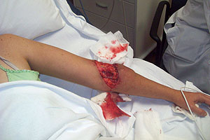graphic image of dog bite