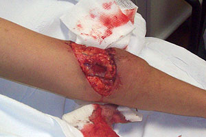 graphic image of dog bite
