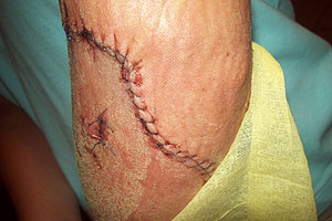 graphic image of dog bite