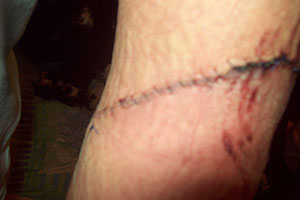 graphic image of dog bite