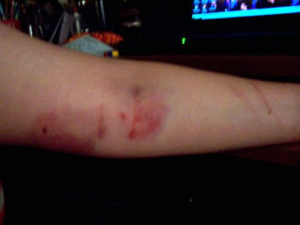 graphic image of dog bite