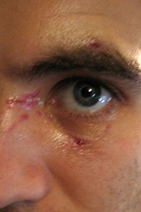 graphic image of dog bite