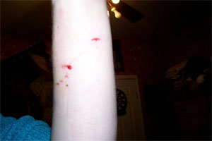 graphic image of dog bite