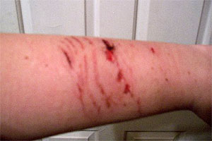 graphic image of dog bite
