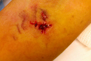 graphic image of dog bite