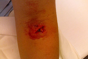 graphic image of dog bite