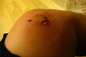 graphic image of dog bite