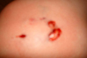 graphic image of dog bite