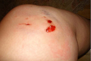 graphic image of dog bite