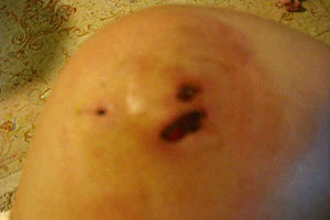 graphic image of dog bite
