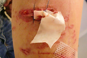 graphic image of dog bite