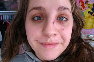 graphic image of dog bite