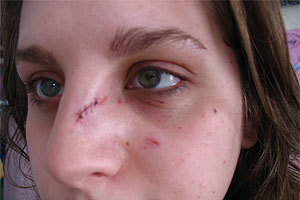 graphic image of dog bite