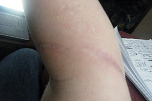 graphic image of dog bite