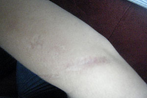 graphic image of dog bite