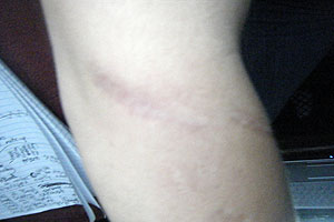 graphic image of dog bite