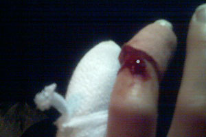 graphic image of dog bite