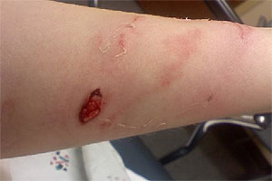 graphic image of dog bite