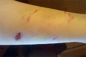 graphic image of dog bite