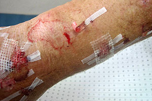 graphic image of dog bite