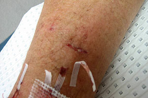 graphic image of dog bite