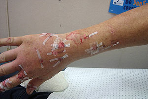 graphic image of dog bite