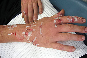 graphic image of dog bite