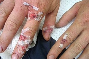 graphic image of dog bite