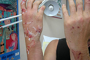 graphic image of dog bite