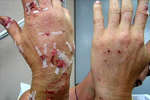 graphic image of dog bite