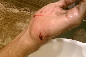 graphic image of dog bite