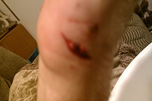 graphic image of dog bite