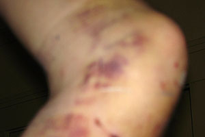 graphic image of dog bite