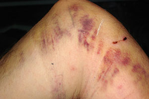 graphic image of dog bite