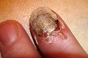 graphic image of dog bite