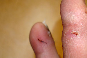 graphic image of dog bite