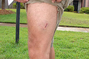 graphic image of dog bite
