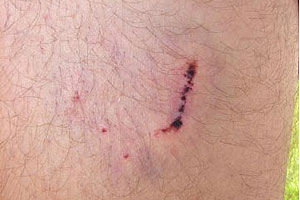 graphic image of dog bite